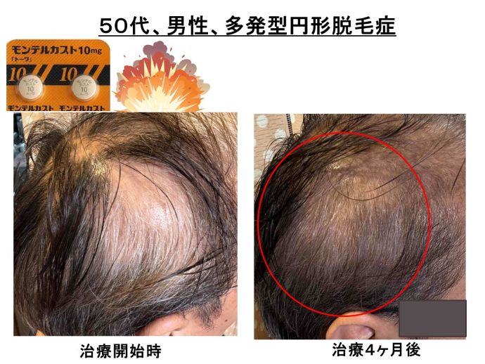 円形脱毛症　病院